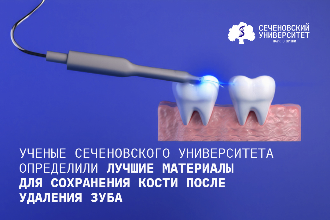 Ученые Сеченовского Университета выяснили, какие материалы лучше всего сохраняют кость после удаления зуба