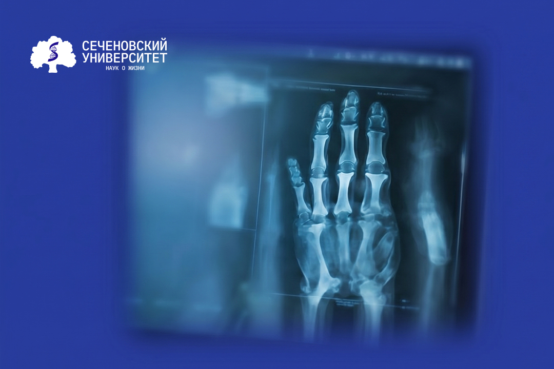 Ученые Сеченовского Университета предложили новый подход к лечению саркомы Юинга, устойчивой к химиотерапии