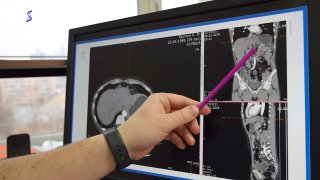 Хирурги Сеченовского Университета удалили пациенту опухоль рядом с сердцем